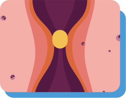 Esophagus with food or liquid passing graphic – How
EOHILIA™ works